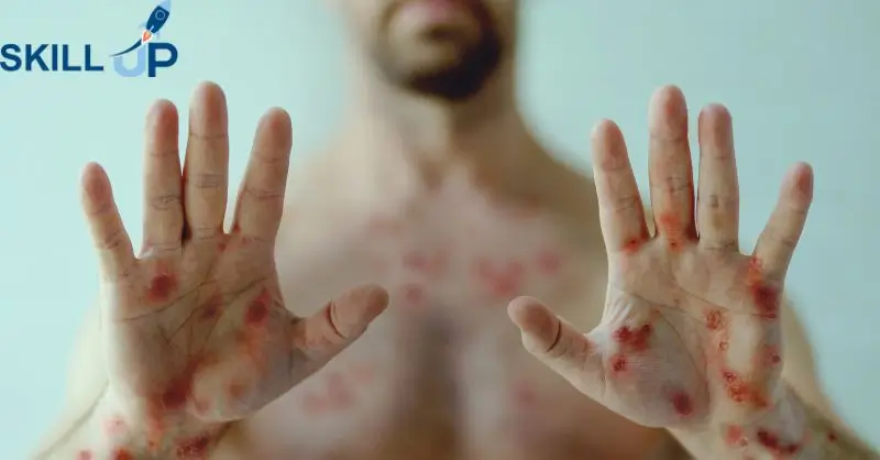 Monkeypox Awareness